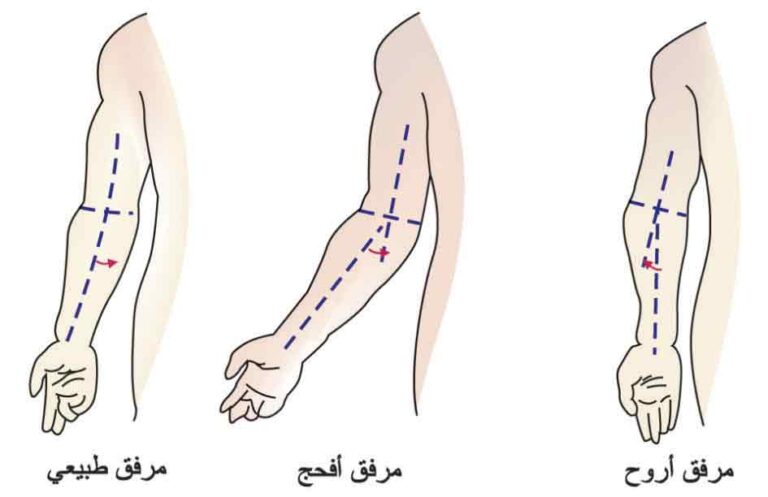 تقوس الذراعين