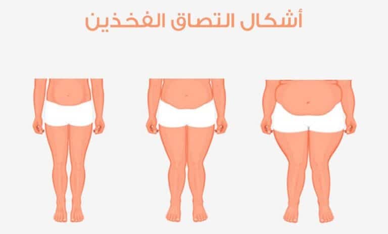 علاج التصاق الفخذين