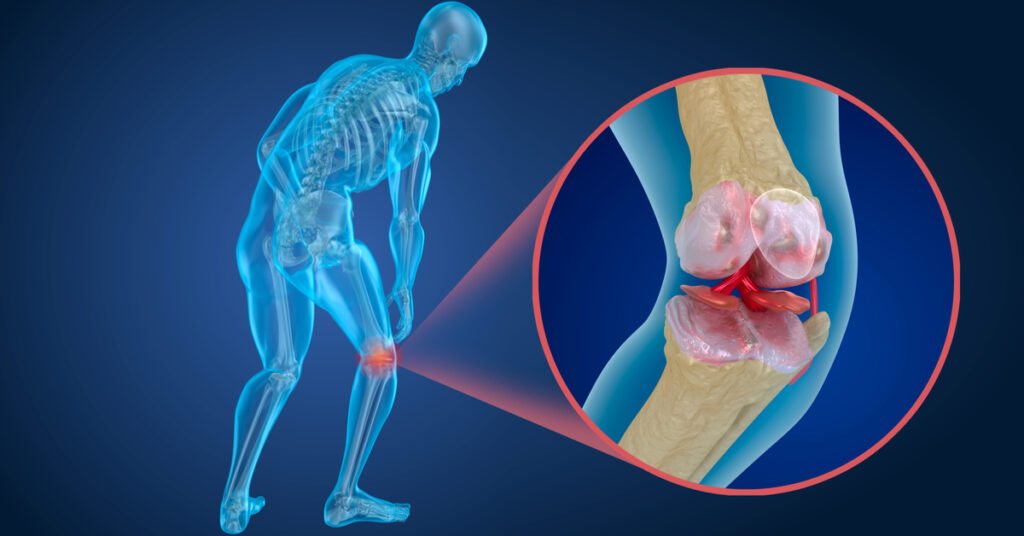 Treatment of erosion of knee cartilage, its causes and does it have a cure?