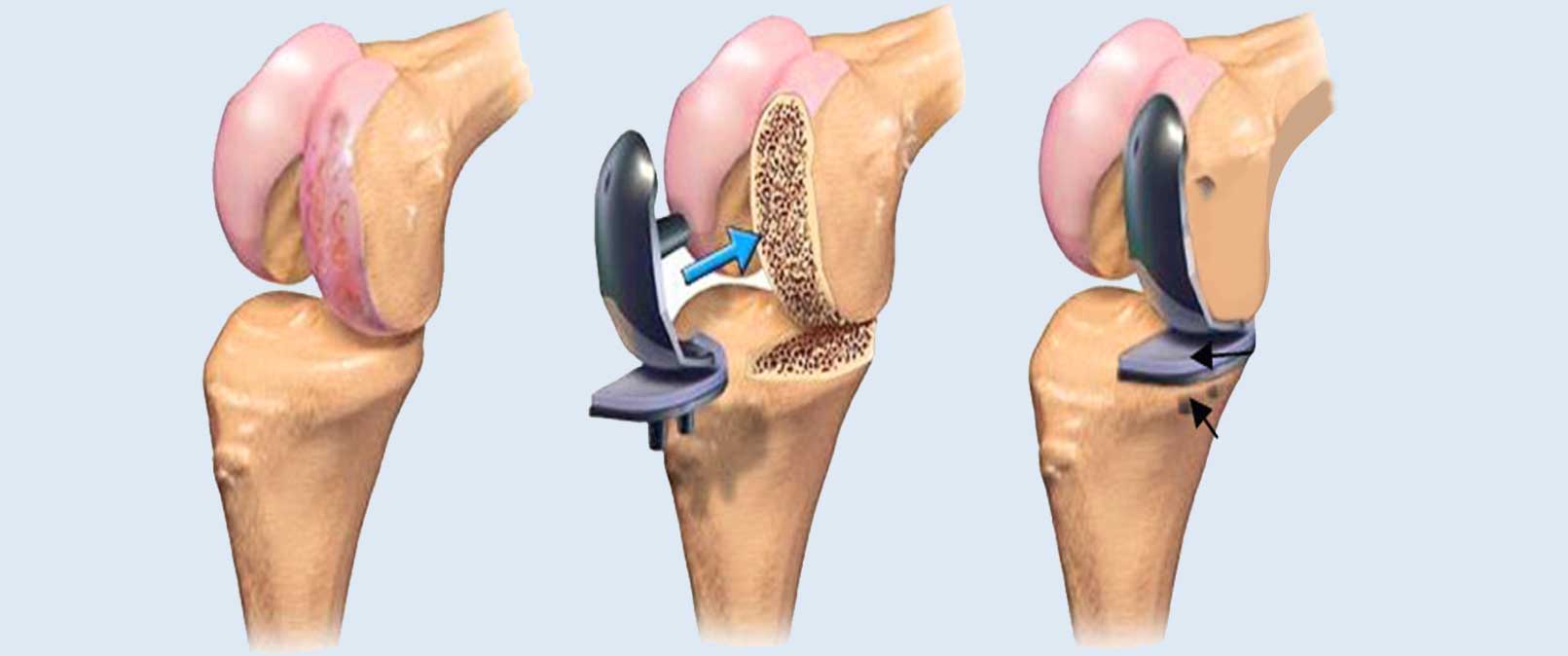 ما هي عملية تغيير مفصل الركبة؟