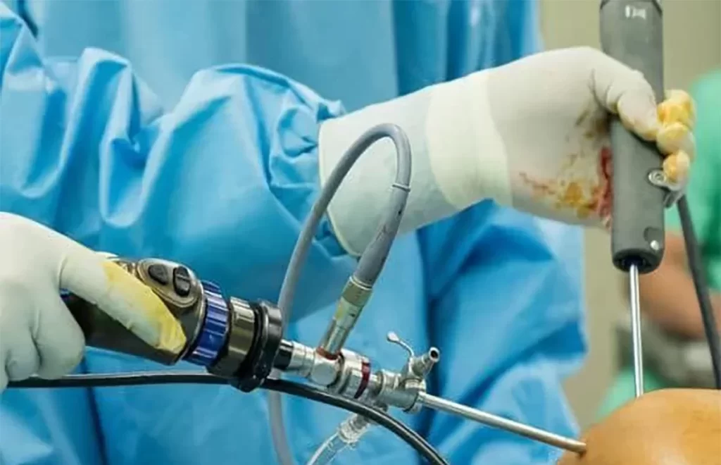 سعر عملية منظار الكتف في مصر