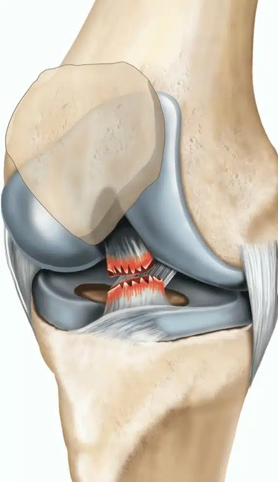 اصابات الرباط الصليبي