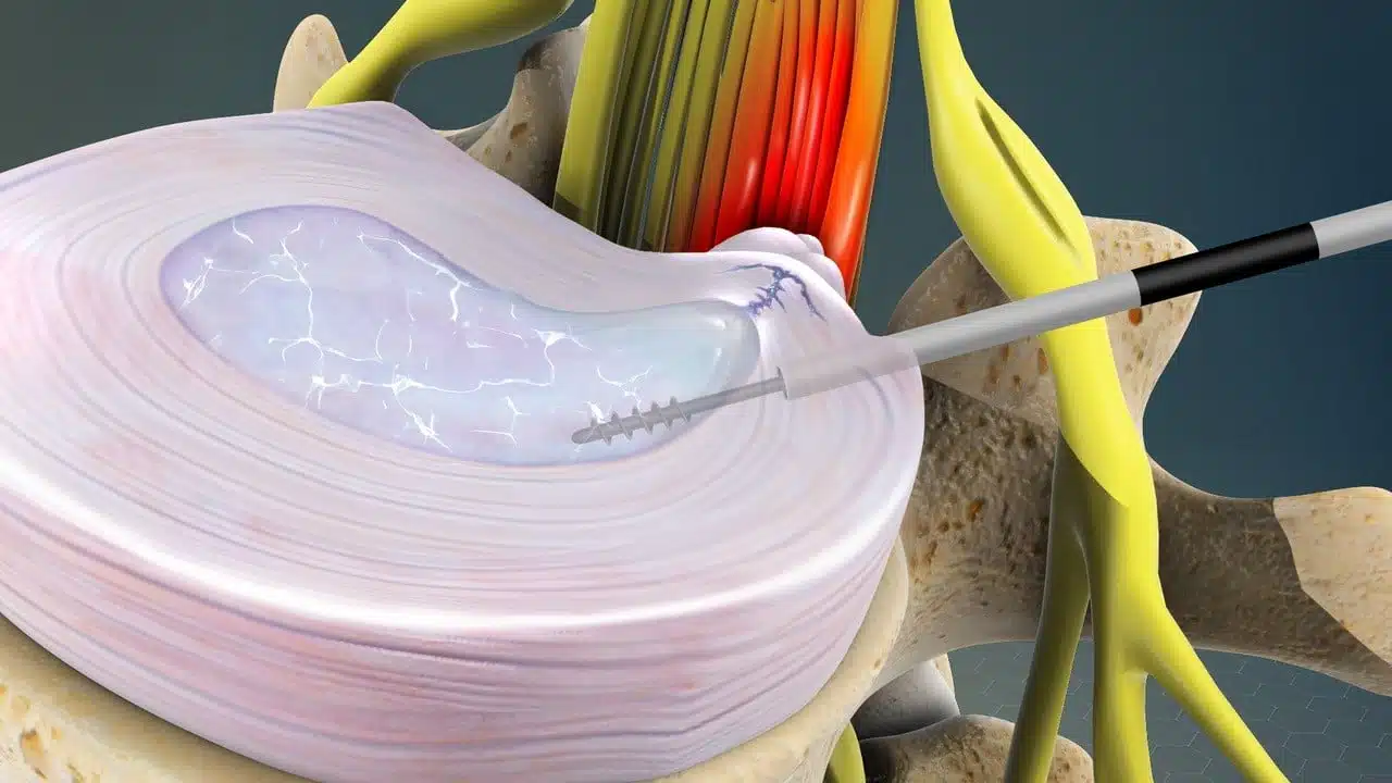 تقنية التردد الحراري ما هي؟