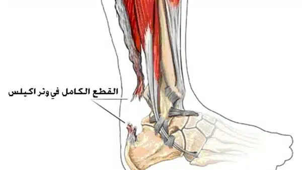 ماذا يحدث عند قطع وتر اكيلس؟