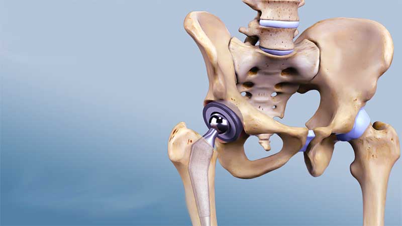 Steps to perform hip replacement surgery