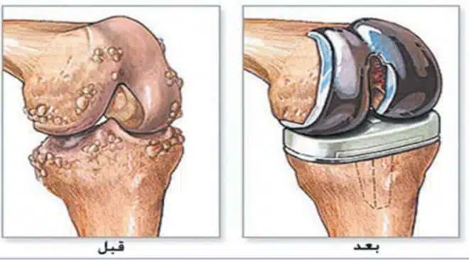 ما هو سعر عملية تغيير مفصل الركبة في مصر؟