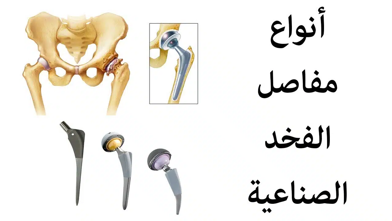 علامَ يعتمد إجمالي تكلفة عملية مفصل الورك الصناعي؟