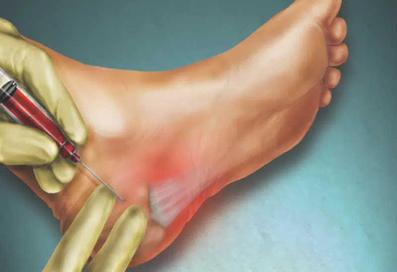 ما هي أضرار عملية الشوكة العظمية؟