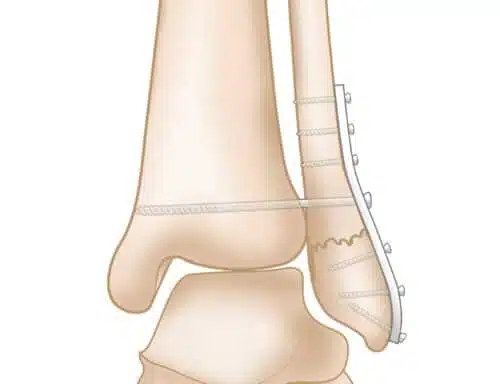 Ankle Plate and Screw Fixation Surgery