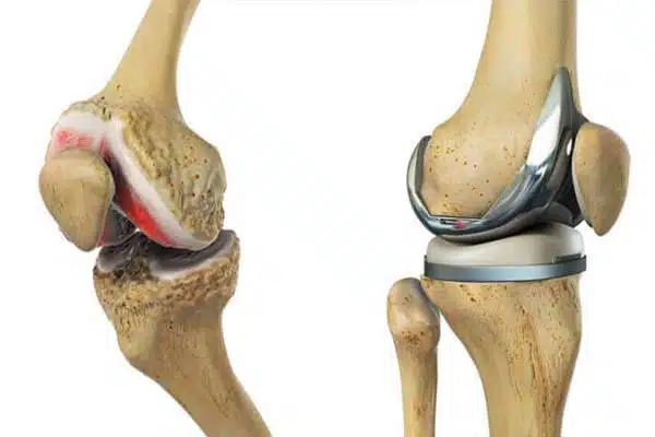 كم تكلفة عملية تركيب مفصل الركبة في مصر؟