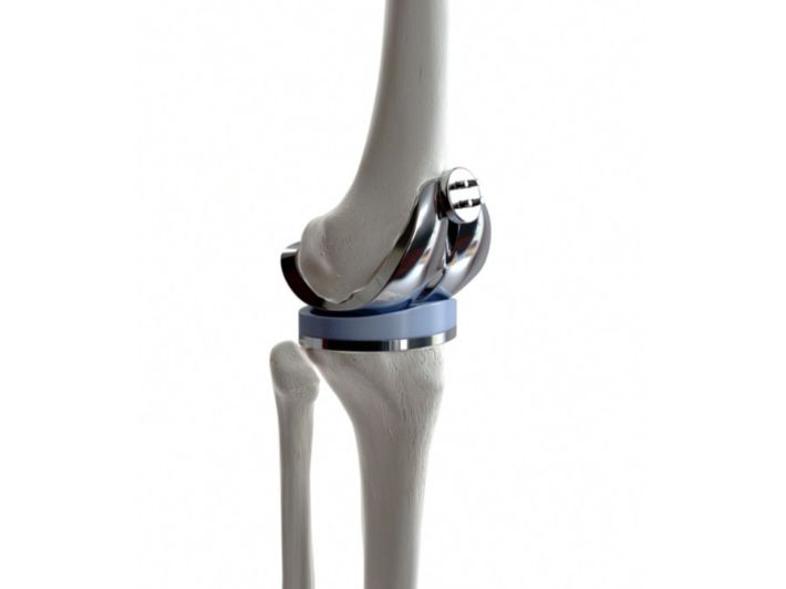 أنواع مفاصل الركبة الاصطناعية
