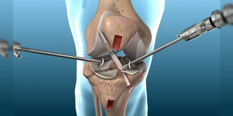 هل من الضروري علاج تمزق أربطة الركبة جراحياً؟