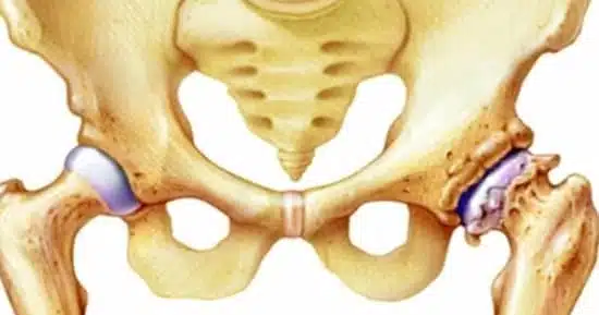 هل كسر الحوض يحتاج عملية؟