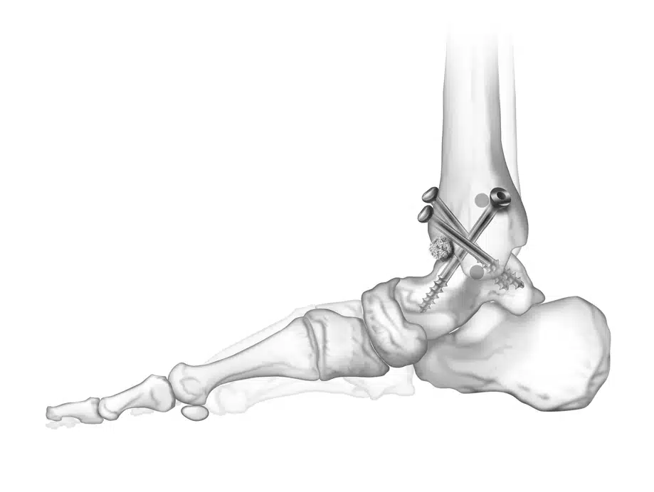 ما هي إجراءات عملية تثبيت مفصل الكاحل؟