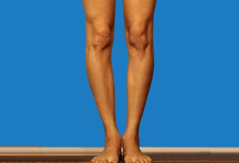  افضل دكتور لعلاج تقوس الساقين