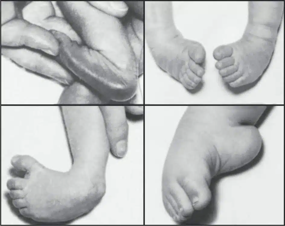 ما هو التدخل الجراحي لعلاج القدم المخلبية؟