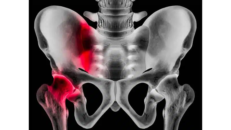 ما هي تكلفة عملية كسر الحوض؟