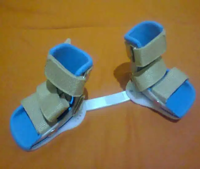 كم مدة لبس حذاء القدم المخلبية؟