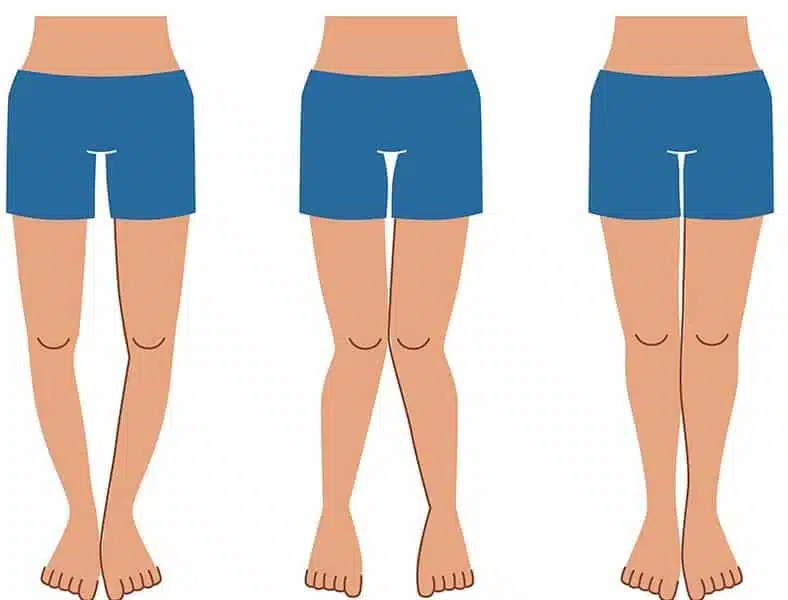 ما هي درجات تقوس الساقين