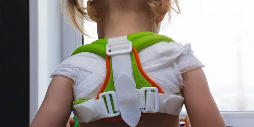 هل يمكن ممارسة الرياضة بعد كسر الترقوة؟