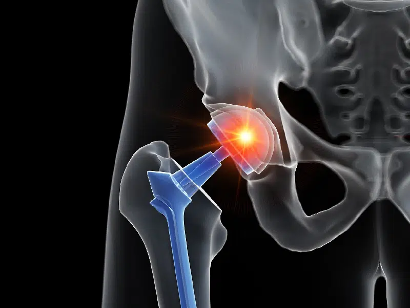 Prothese hanche 64376