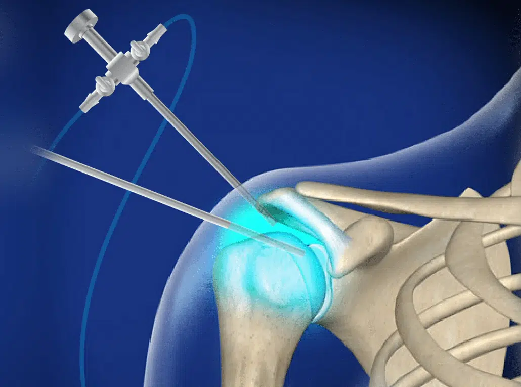 ما هي عوامل زيادة نسبة نجاح عملية منظار الكتف؟