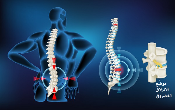 What are the Symptoms of Disc Herniation? And Is Sitting Dangerous for the Patient?