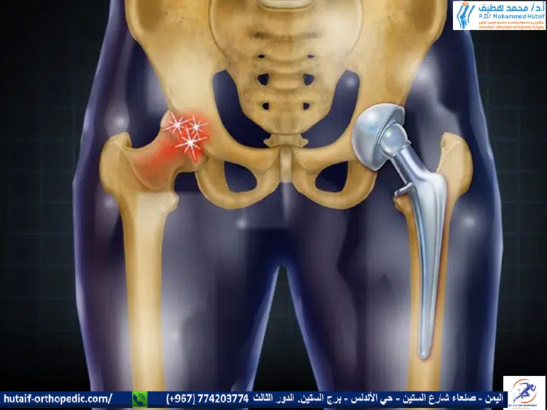 خطوات إجراء عملية تغيير مفصل الحوض