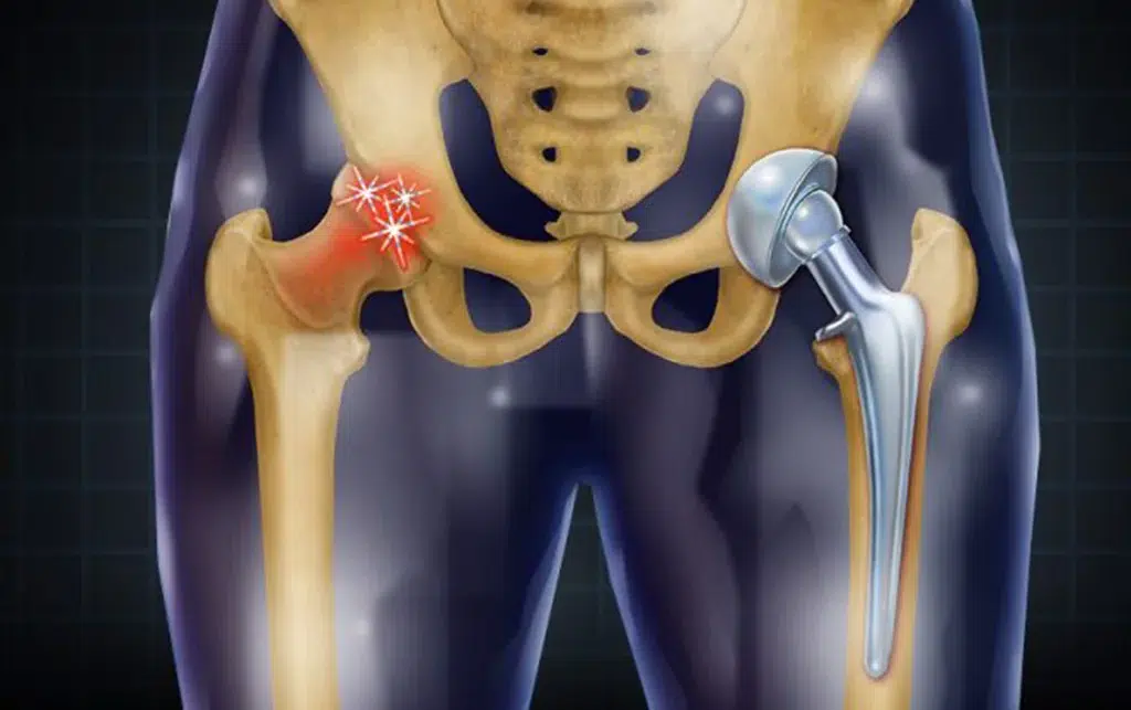 سعر عملية تغيير مفصل الحوض في مصر