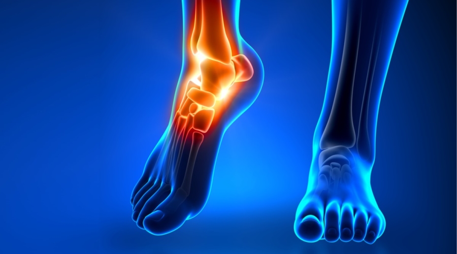Rheumatoid arthritis of the foot and ankle