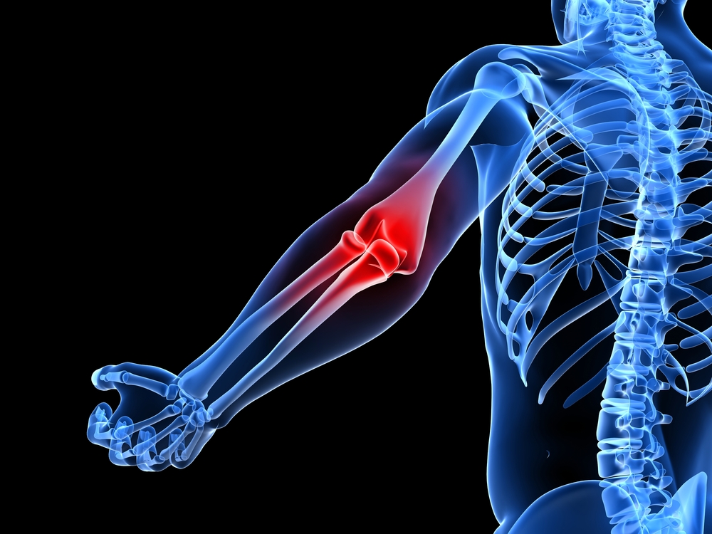 Cases of resorting to elbow joint replacement surgery