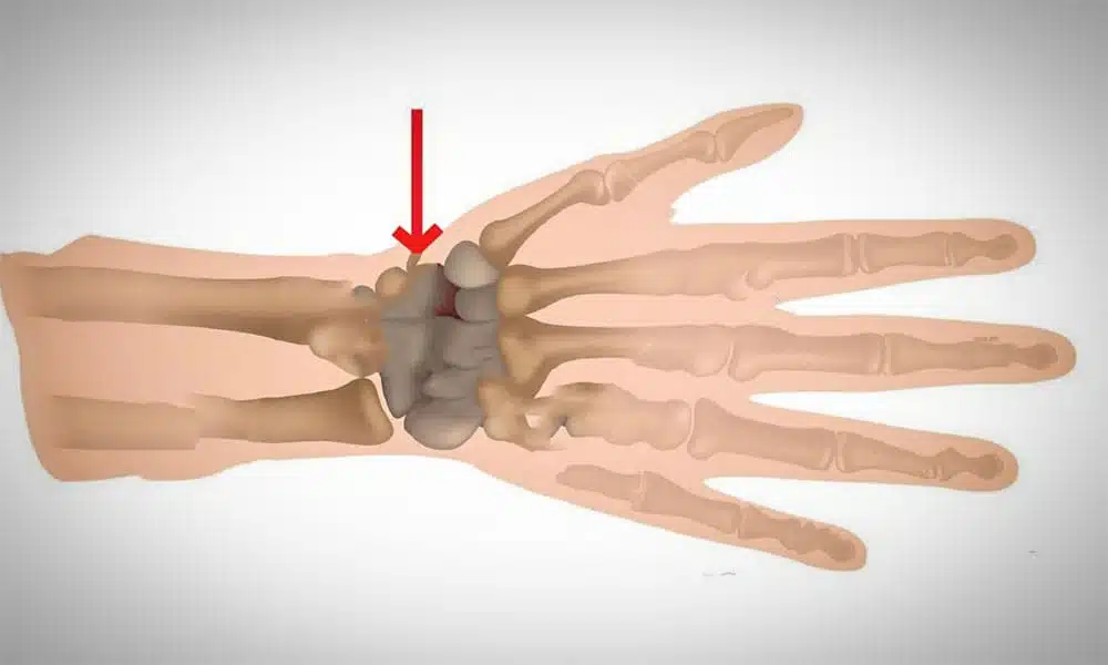 عملية ترقيع عظمة الزورقية