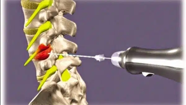 كي الغضروف بالليزر