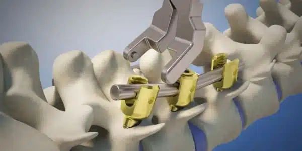 ما هي عملية تثبيت الفقرات؟