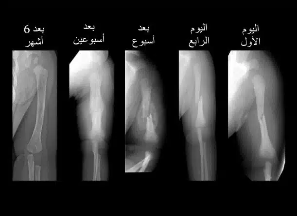 كيفية التشخيص قبل عملية ترقيع عظام الساق