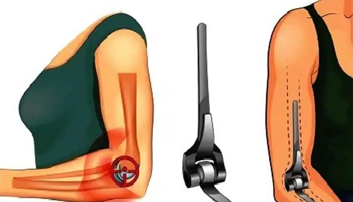 كيفية إجراء عملية تغيير مفصل الكوع