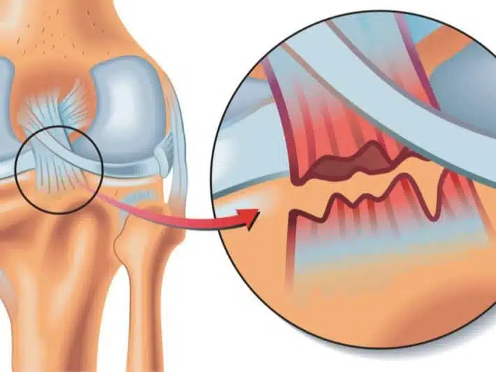 أعراض تمزق الرباط الصليبي