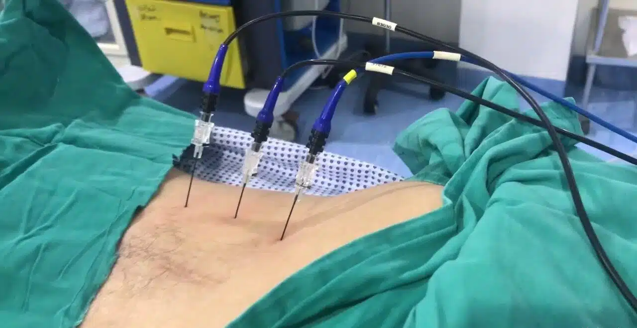 هل العلاج بالتردد الحراري مؤلم؟