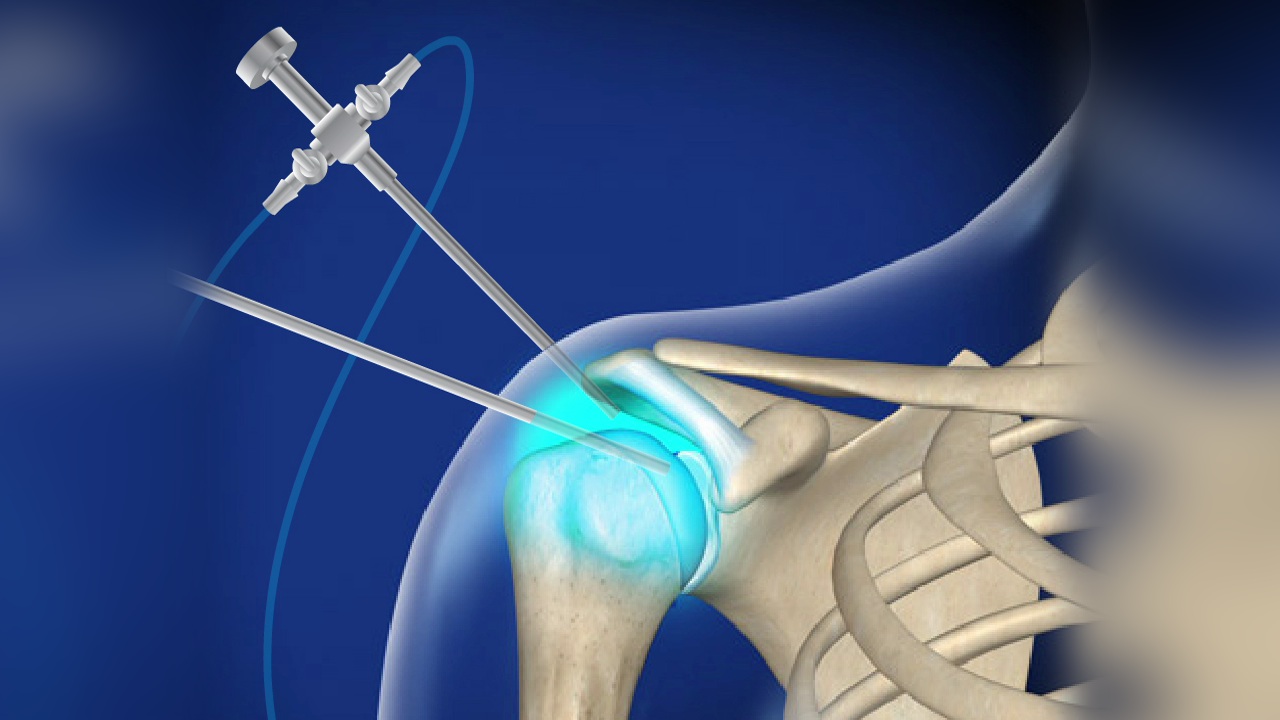 After shoulder arthroscopy