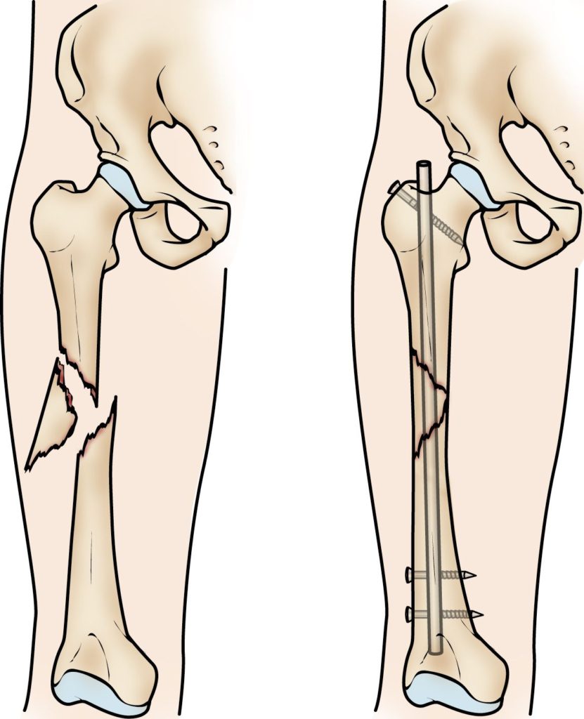 ?Learn about the process of installing a plate in the femur bone and what are the symptoms of this fracture occurring