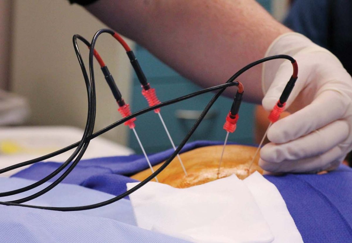 How radiofrequency ablation works