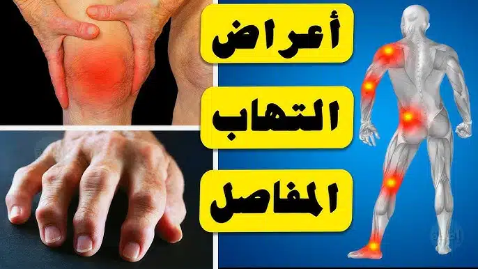 أعراض التهاب المفاصل
