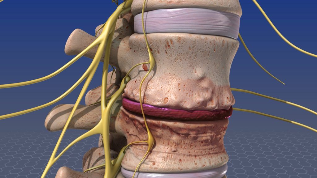 Learn more about neck disc operations and when a patient may undergo discectomy