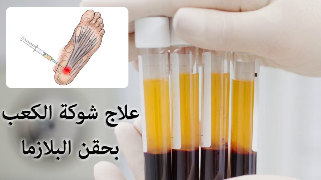 سعر حقنة الشوكة العظمية