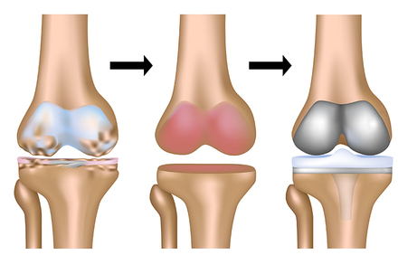 !Knee replacement surgery and the most prominent causes that require its replacement