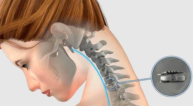 !The cost of neck cartilage surgery and the top 5 distinct symptoms of its presence