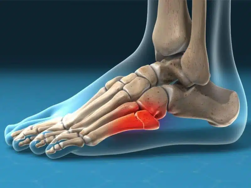 Is bone spur disease chronic?