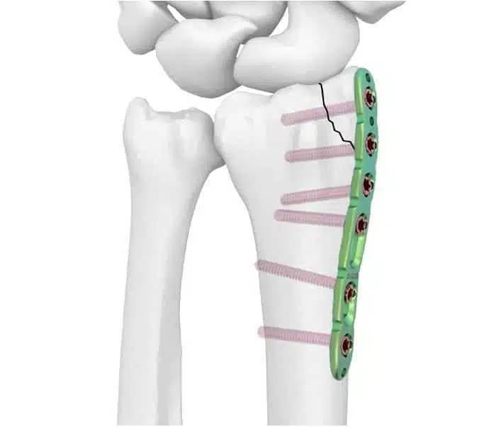 هل يمكن إزالة المسمار النخاعي بعد عملية تركيبه؟