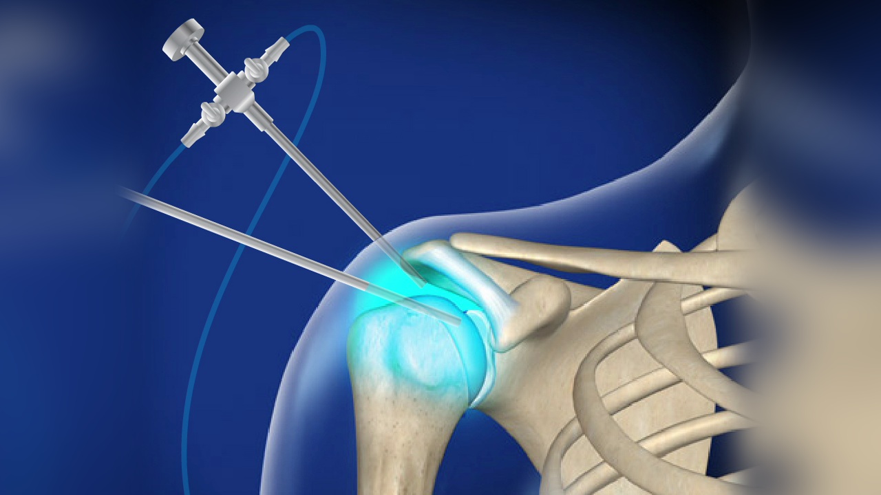 Discover Shoulder Arthroscopy Prices in Egypt and Important Post-Procedure Tips