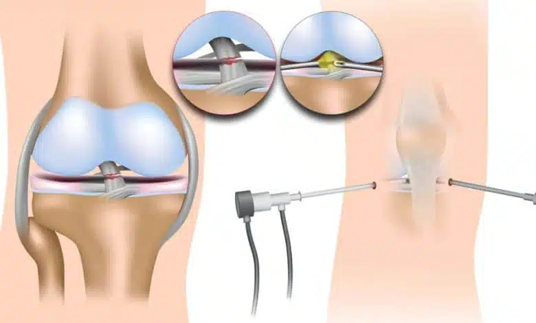 هل يلتئم الرباط الصليبي الخلفي من تلقاء نفسه؟